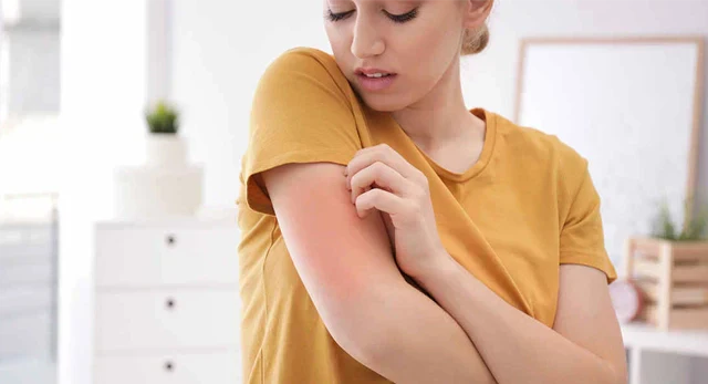 comment-soulager-eczema-produits-naturels