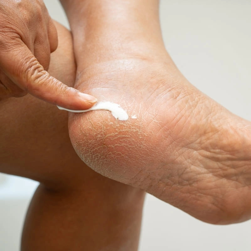 Application de crème hydratante sur pieds secs - NaturAloé