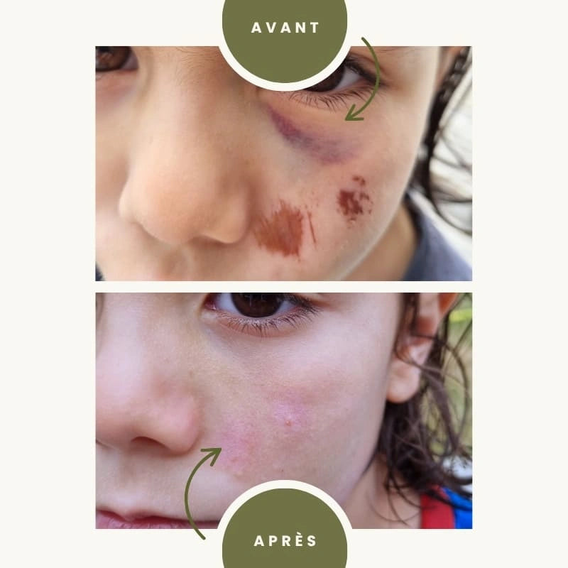 Gel Originel d'Aloé Vera Bio - Avant après cicatrisation - NaturAloé