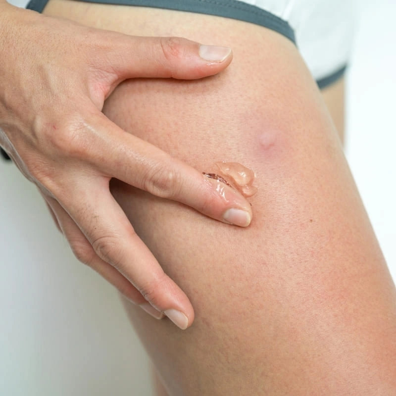 Application du gel multi-actions sur bouton de moustique - NaturAloé