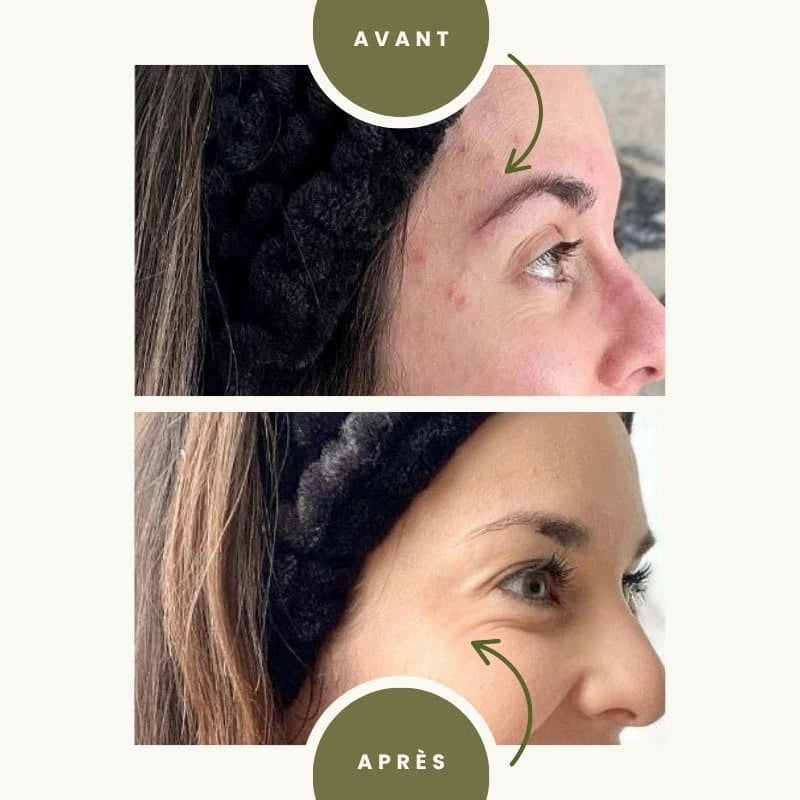 Gel purifiant à l'Aloé Vera Bio - Avant après acné - NaturAloé