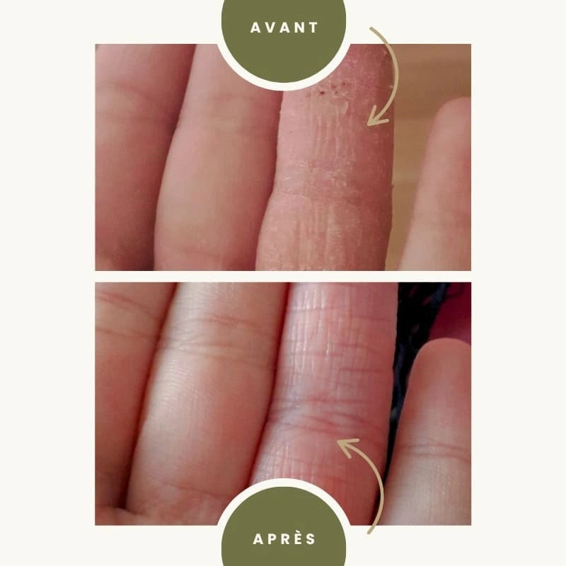 Gel purifiant à l'Aloé Vera Bio - Avant après eczéma - NaturAloé
