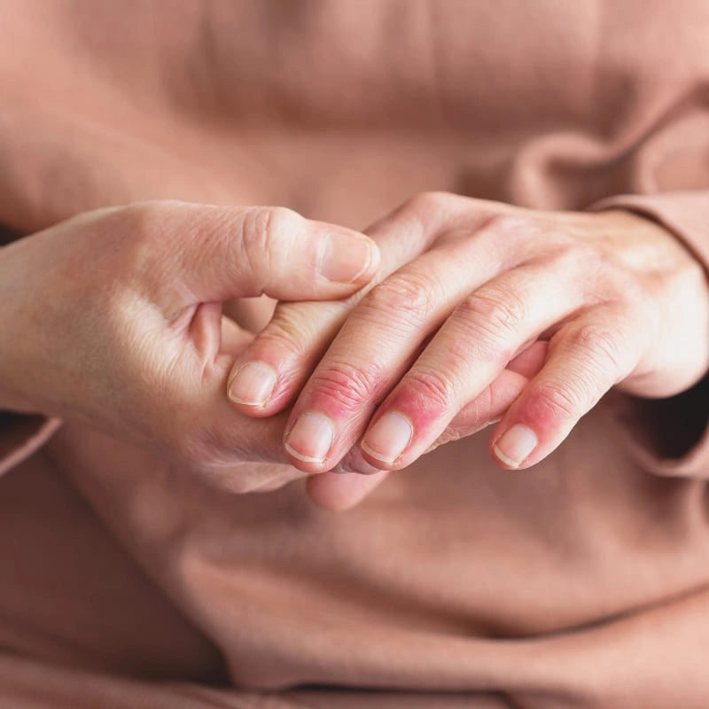 Application de gel Propolis sur les mains avec eczéma - NaturAloé